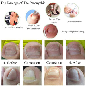 10pcs Ingrown Toenail Correction Clips