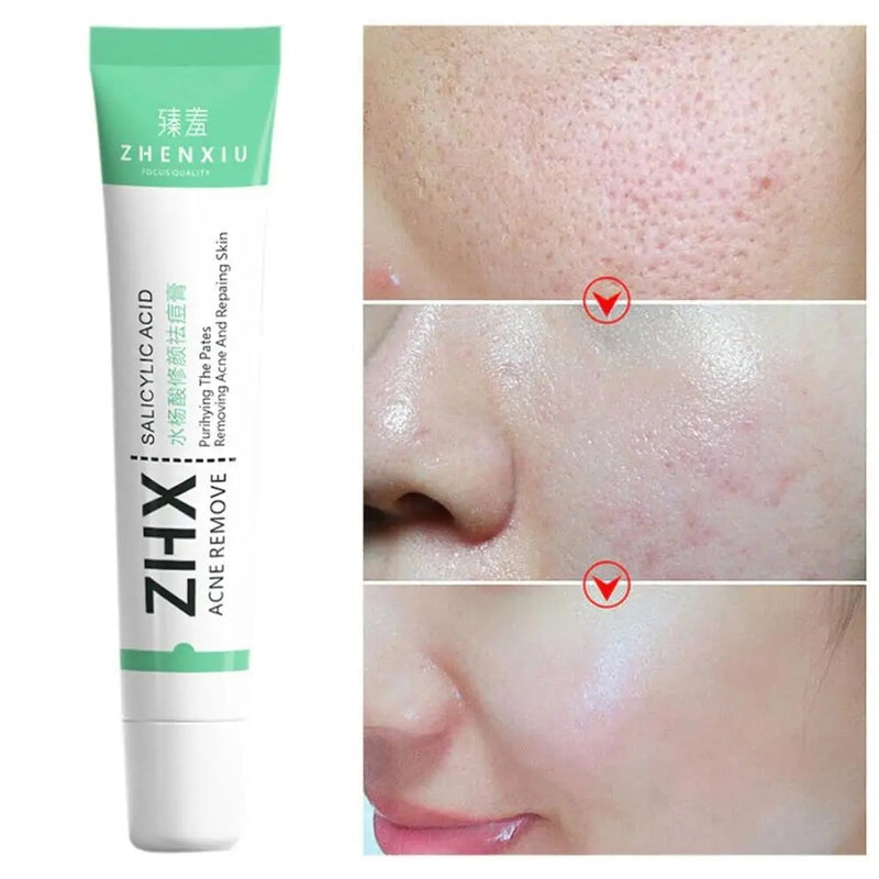 20g Salicylic Acid Acne Removal Cream for Clear Skin