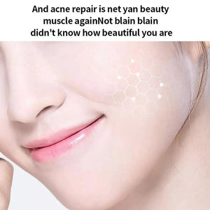 20g Salicylic Acid Acne Removal Cream for Clear Skin