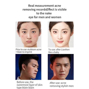 20g Salicylic Acid Acne Removal Cream for Clear Skin