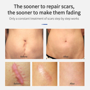 Scar Removal Cream Remove Acne Spots Treatment Stretch Marks Surgical Burns