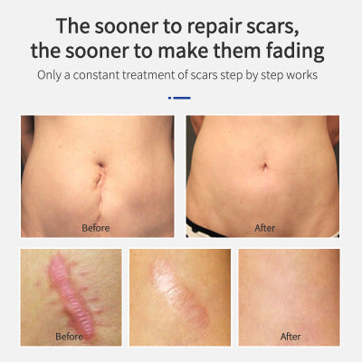 Scar Removal Cream Remove Acne Spots Treatment Stretch Marks Surgical Burns