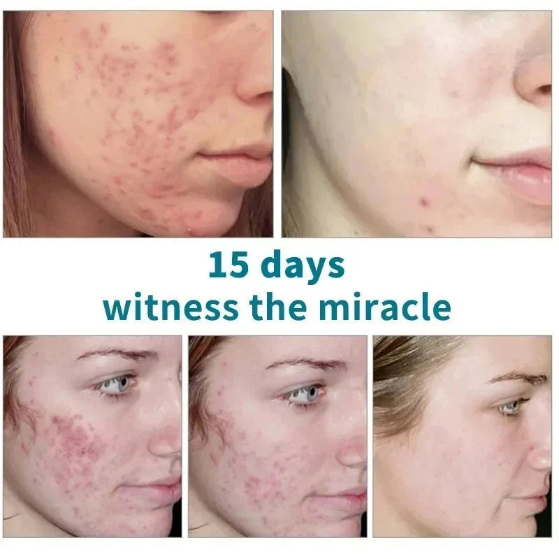 Acne Scar Repair Cream for Pores, Blackheads, and Skin Smoothing