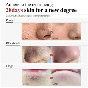 Acne Scar Repair Cream for Pores, Blackheads, and Skin Smoothing