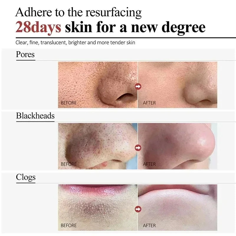 Acne Scar Repair Cream for Pores, Blackheads, and Skin Smoothing