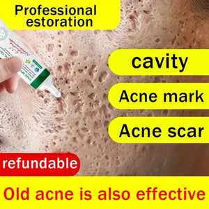 Acne Scar Repair Cream for Pores, Blackheads, and Skin Smoothing