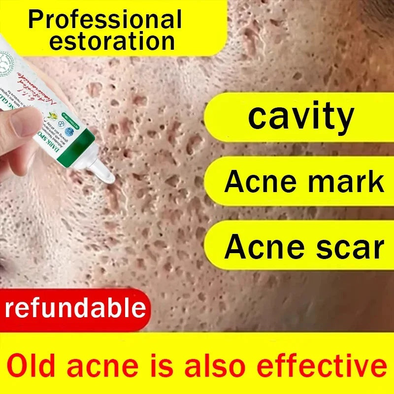 Acne Scar Repair Cream for Pores, Blackheads, and Skin Smoothing