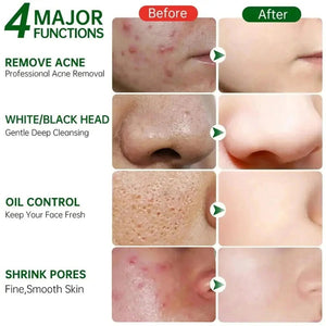 Acne Scar Repair Cream for Pores, Blackheads, and Skin Smoothing