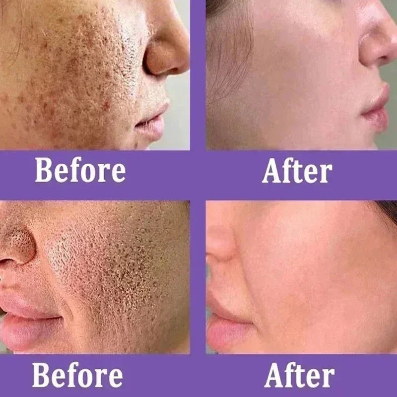Acne Scar Repair Cream for Pores, Blackheads, and Skin Smoothing