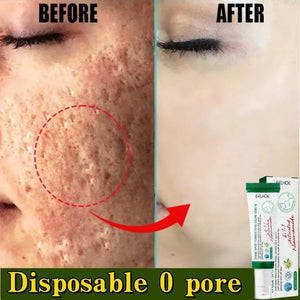 Acne Scar Repair Cream for Pores, Blackheads, and Skin Smoothing