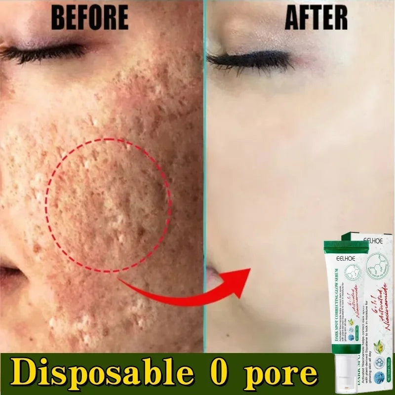 Acne Scar Repair Cream for Pores, Blackheads, and Skin Smoothing