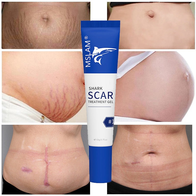 Scar Removal Cream Remove Acne Spots Treatment Stretch Marks Surgical Burns