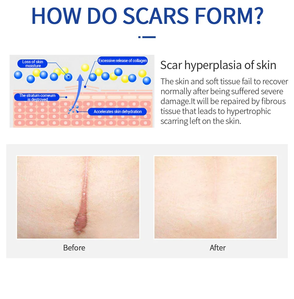 Scar Removal Cream Remove Acne Spots Treatment Stretch Marks Surgical Burns
