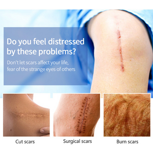 Scar Removal Cream Remove Acne Spots Treatment Stretch Marks Surgical Burns