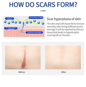 Scar Removal Cream Remove Acne Spots Treatment Stretch Marks Surgical Burns
